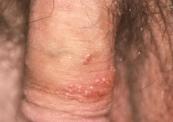 Emri:  men-genital-human-papillomavirus--hpv.jpg

Shikime: 29342

Madhsia:  64.2 KB