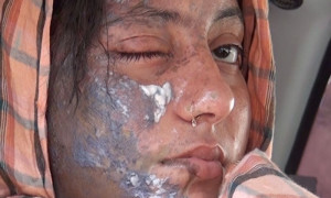 Emri:  pakistani-woman-with-acid-burns-300x180.jpg

Shikime: 3287

Madhsia:  20.2 KB